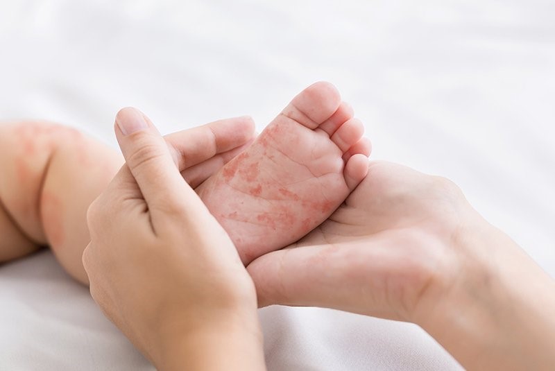 Làn da nhạy cảm của trẻ cần được bảo vệ khỏi các tác nhân gây dị ứng